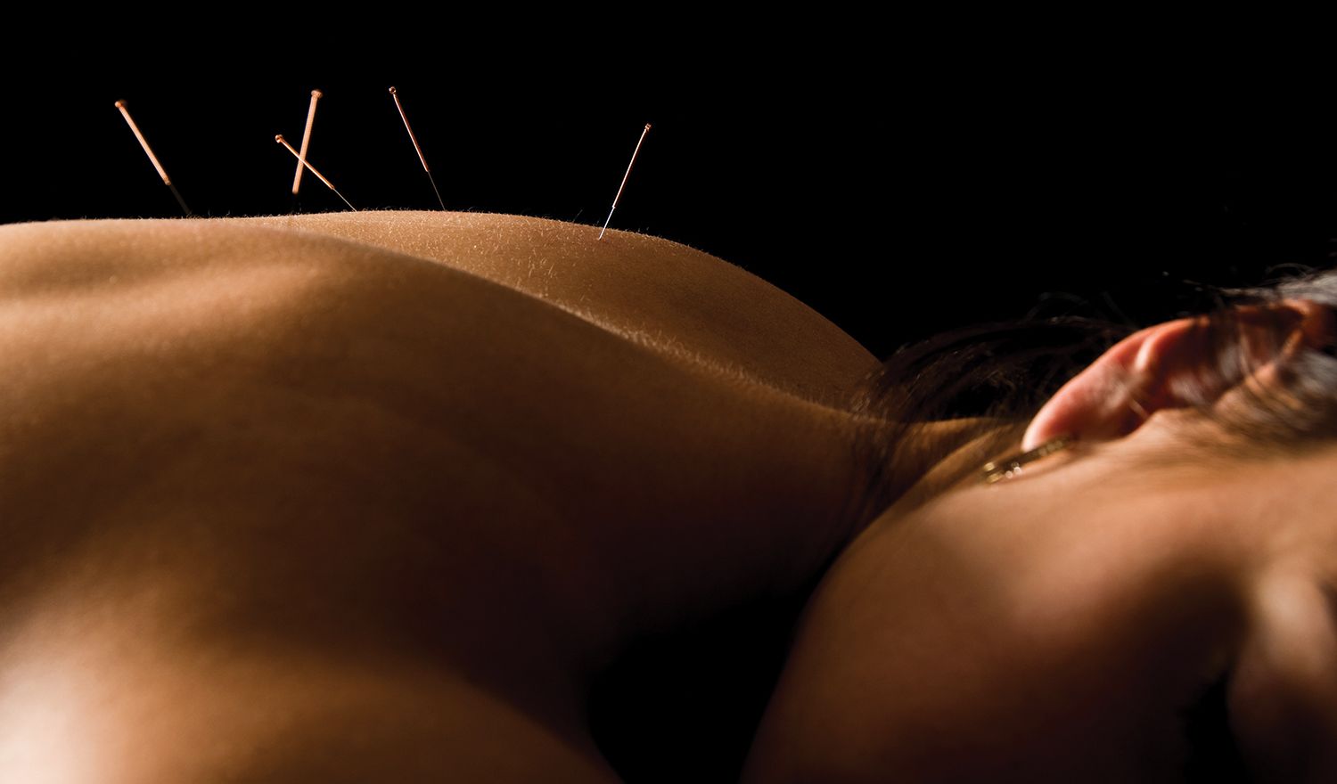 Acupuncture